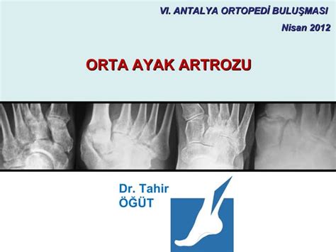 ayak artrozu cerrahi tedavisi